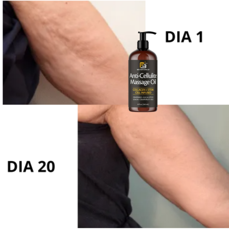 Aceite-Tratamiento para la celulitis